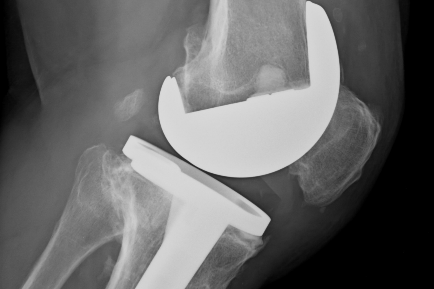 Prótesis de Rodilla